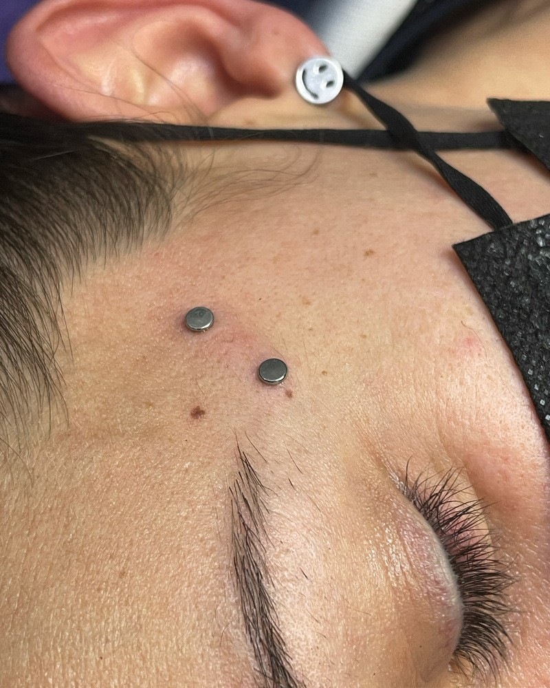 Piercing surface microdermal 2022 03 15 18 35 49
